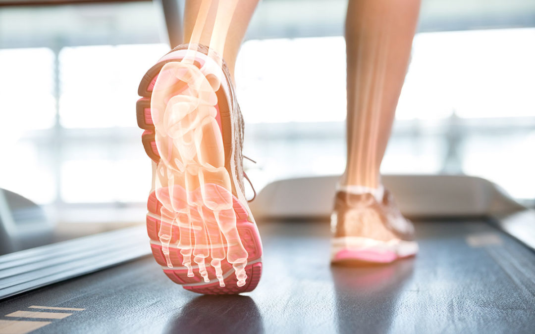 What is Plantar Fasciitis